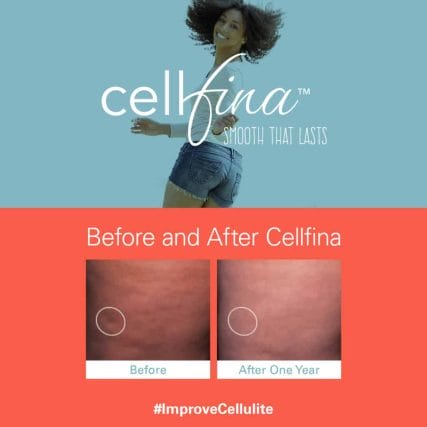 cellfina-cellulite-treatment-miami-carlos-spera-9