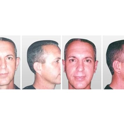 ear-surgery-miami-carlos-spera-1