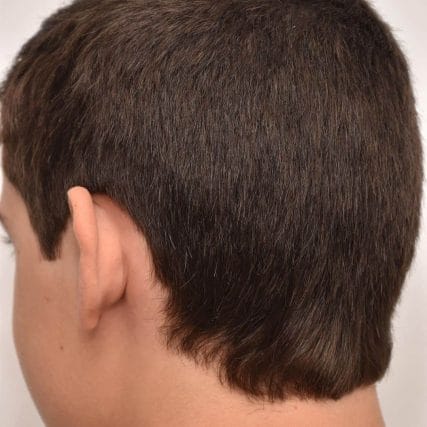 ear-surgery-miami-carlos-spera-10