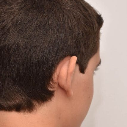 ear-surgery-miami-carlos-spera-11