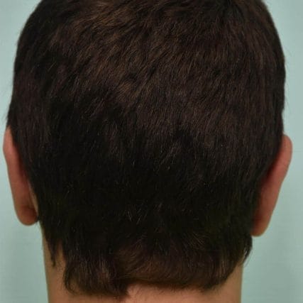 ear-surgery-miami-carlos-spera-12