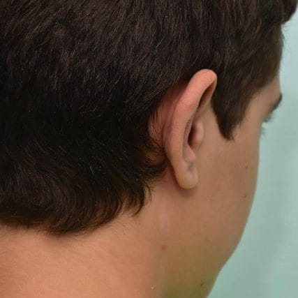 ear-surgery-miami-carlos-spera-13