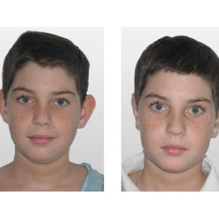 ear-surgery-miami-carlos-spera-2