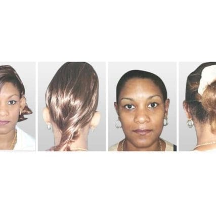 ear-surgery-miami-carlos-spera-3