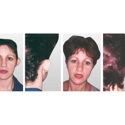 ear-surgery-miami-carlos-spera-4