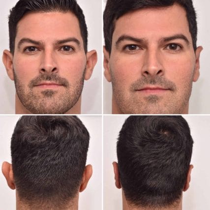 ear-surgery-miami-carlos-spera-5