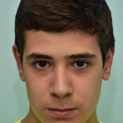 ear-surgery-miami-carlos-spera-8