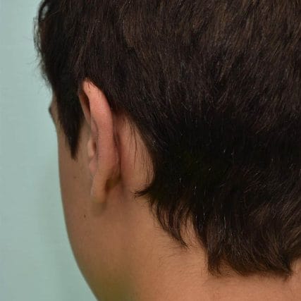 ear-surgery-miami-carlos-spera-9