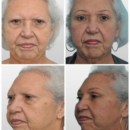 endoscopic-browlift-miami-carlos-spera-1