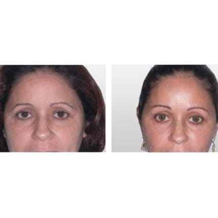 endoscopic-browlift-miami-carlos-spera-2