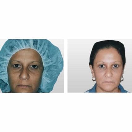 endoscopic-browlift-miami-carlos-spera-3
