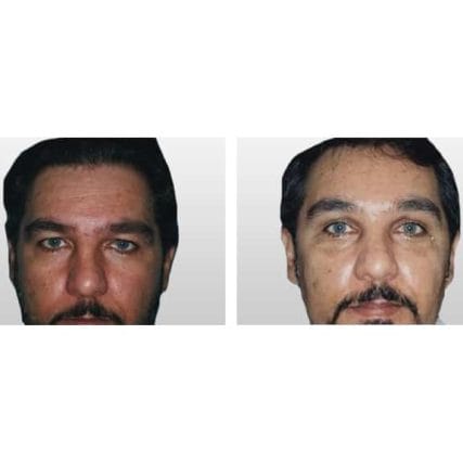 endoscopic-browlift-miami-carlos-spera-4