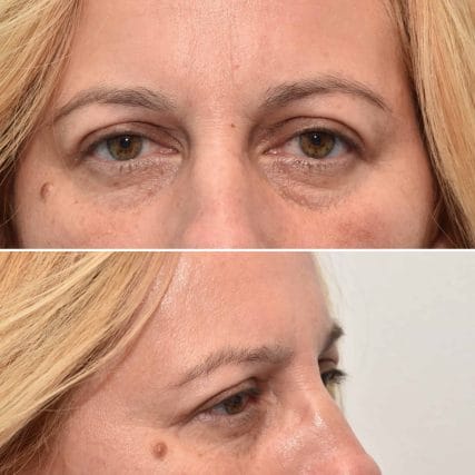 eyelid-surgery-miami-carlos-spera-1