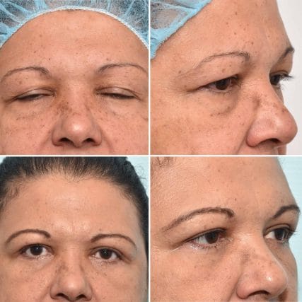 eyelid-surgery-miami-carlos-spera-10
