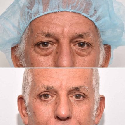 eyelid-surgery-miami-carlos-spera-11