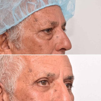 eyelid-surgery-miami-carlos-spera-12
