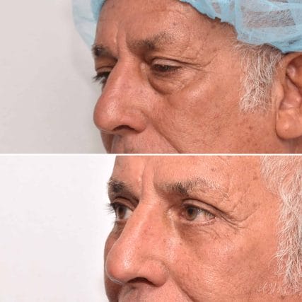 eyelid-surgery-miami-carlos-spera-13