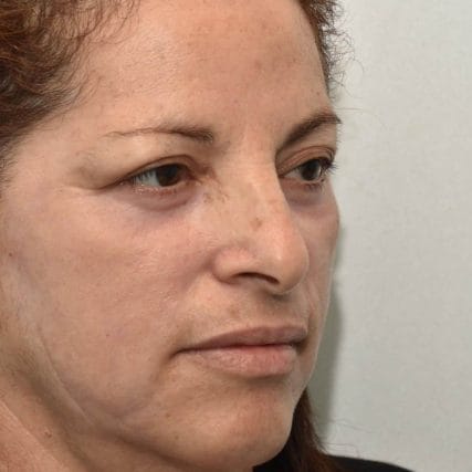 eyelid-surgery-miami-carlos-spera-15