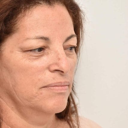 eyelid-surgery-miami-carlos-spera-16