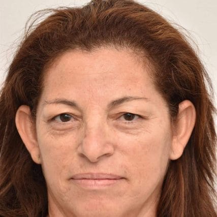 eyelid-surgery-miami-carlos-spera-17