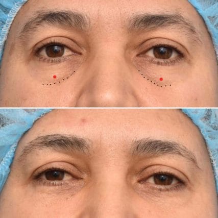 eyelid-surgery-miami-carlos-spera-18