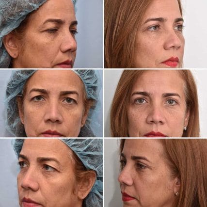 eyelid-surgery-miami-carlos-spera-19