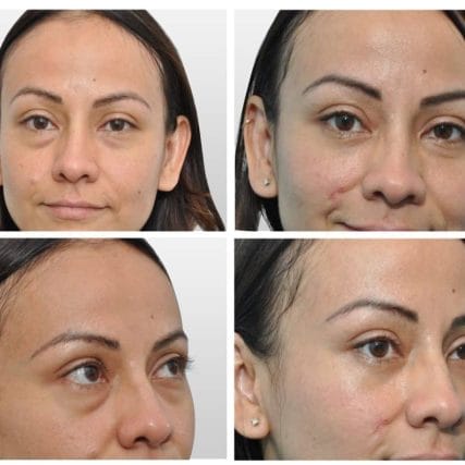 eyelid-surgery-miami-carlos-spera-2