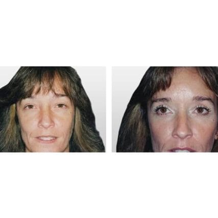 eyelid-surgery-miami-carlos-spera-3