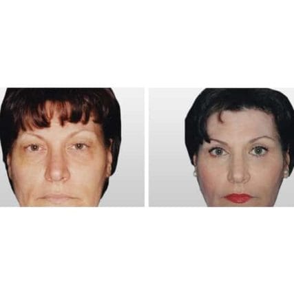 eyelid-surgery-miami-carlos-spera-4
