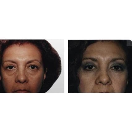 eyelid-surgery-miami-carlos-spera-5