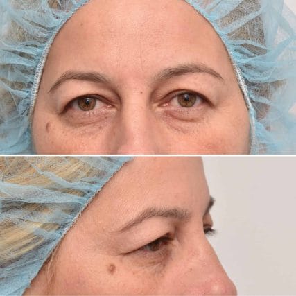 eyelid-surgery-miami-carlos-spera-6