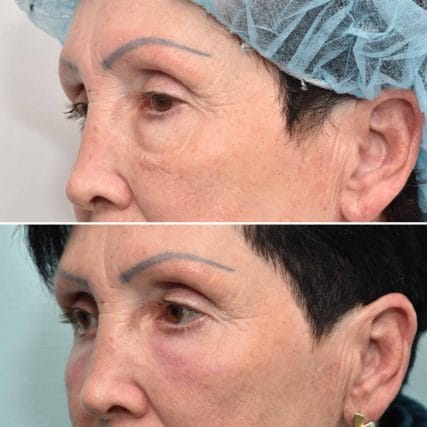 eyelid-surgery-miami-carlos-spera-7