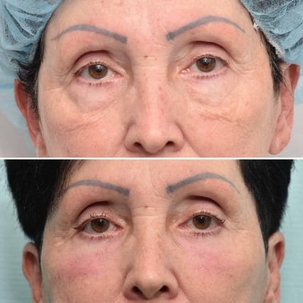 eyelid-surgery-miami-carlos-spera-8