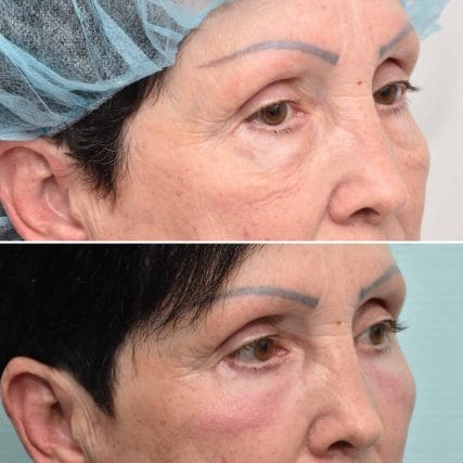 eyelid-surgery-miami-carlos-spera-9