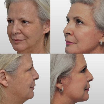 face-lift-rhytidectomy-miami-carlos-spera-1