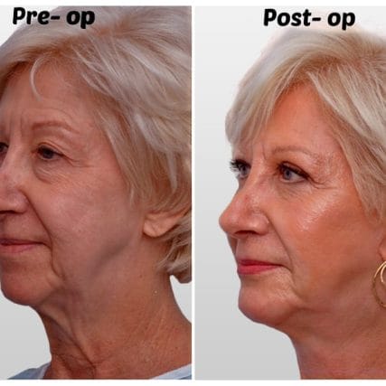 face-lift-rhytidectomy-miami-carlos-spera-10