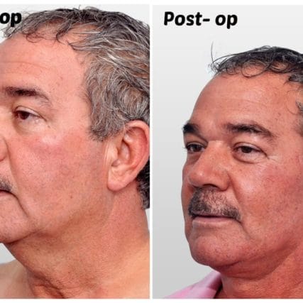 face-lift-rhytidectomy-miami-carlos-spera-11