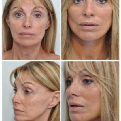 face-lift-rhytidectomy-miami-carlos-spera-12