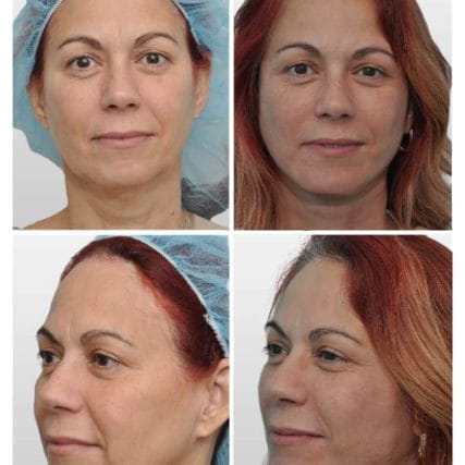 face-lift-rhytidectomy-miami-carlos-spera-13