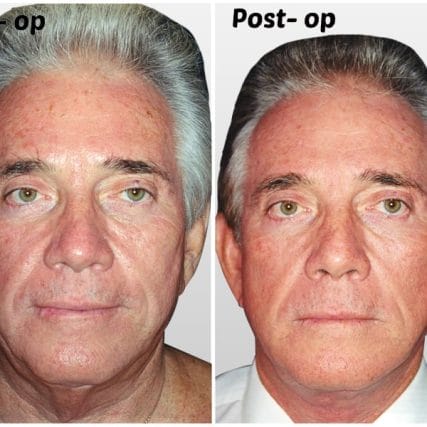face-lift-rhytidectomy-miami-carlos-spera-14