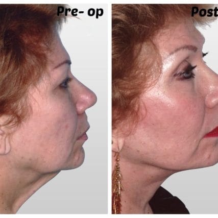 face-lift-rhytidectomy-miami-carlos-spera-15