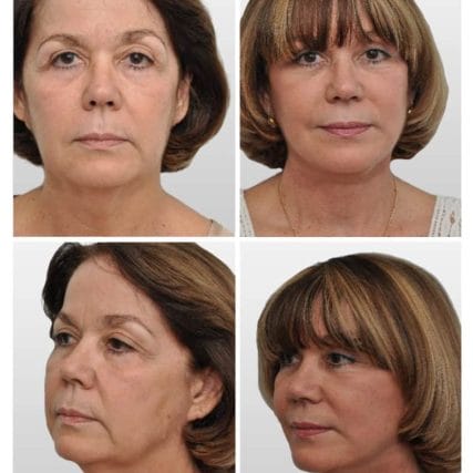 face-lift-rhytidectomy-miami-carlos-spera-16