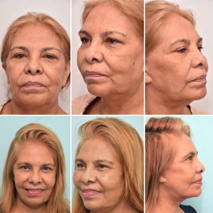 face-lift-rhytidectomy-miami-carlos-spera-17
