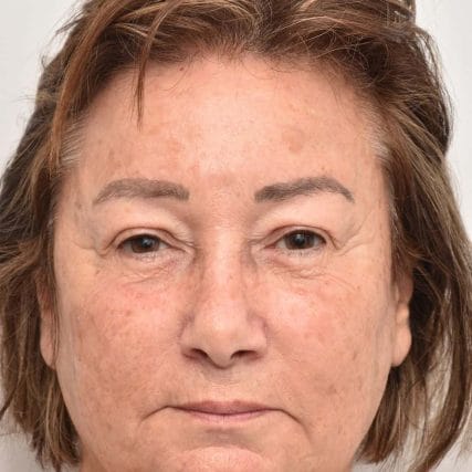 face-lift-rhytidectomy-miami-carlos-spera-18