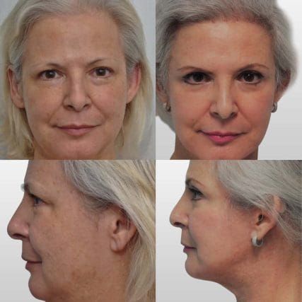 face-lift-rhytidectomy-miami-carlos-spera-2