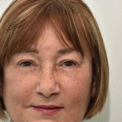 face-lift-rhytidectomy-miami-carlos-spera-20