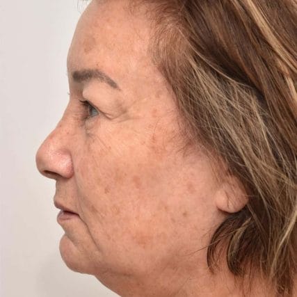 face-lift-rhytidectomy-miami-carlos-spera-21