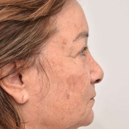 face-lift-rhytidectomy-miami-carlos-spera-22