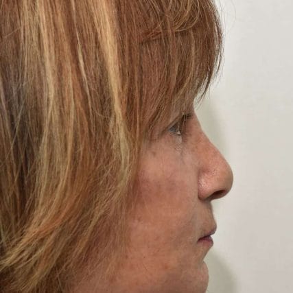 face-lift-rhytidectomy-miami-carlos-spera-23