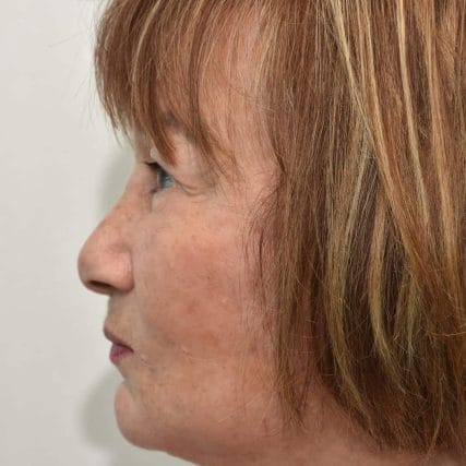 face-lift-rhytidectomy-miami-carlos-spera-24